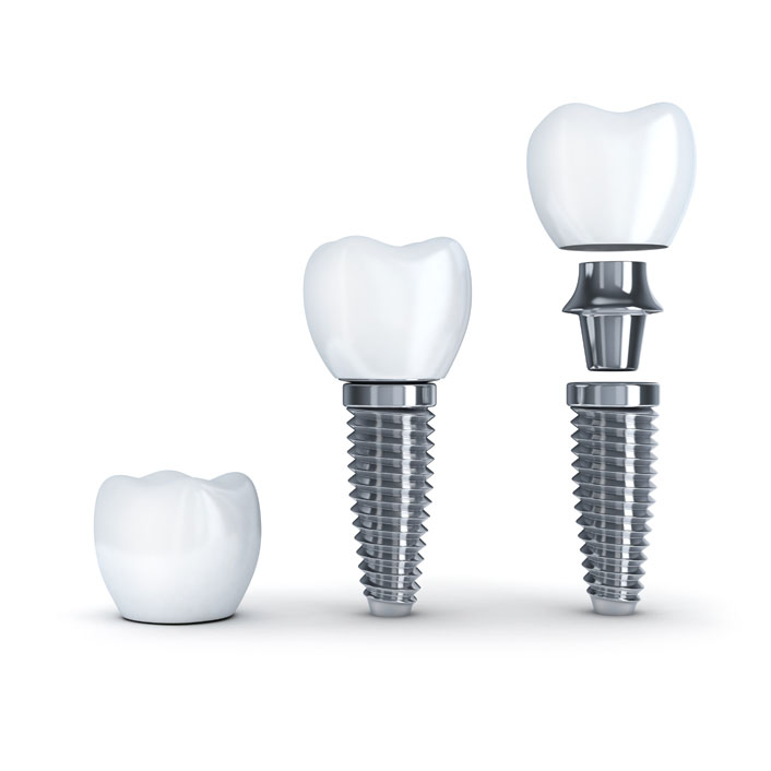 Implant Restorations - Dental Services